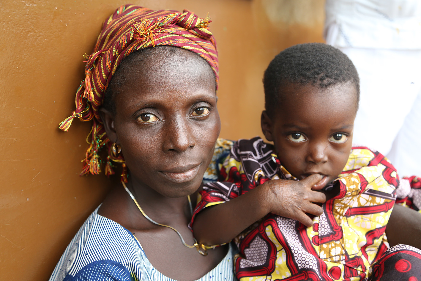 fighting-buruli-ulcer-benin--fundacion-anesvad Fighting Buruli Ulcer In Benin. Fundacion Anesvad