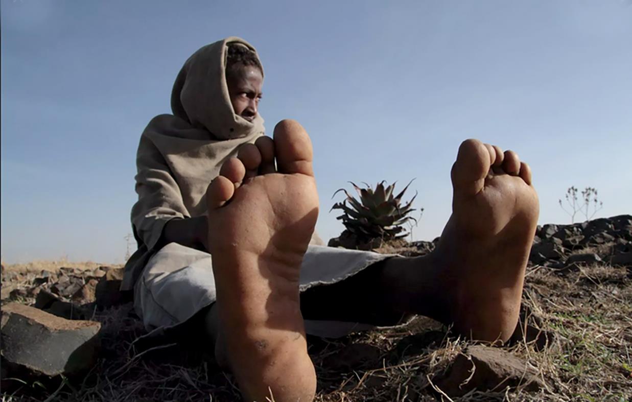 Preventing-Mycetoma-Sudan-2019 Preventing-Mycetoma-Sudan-2019